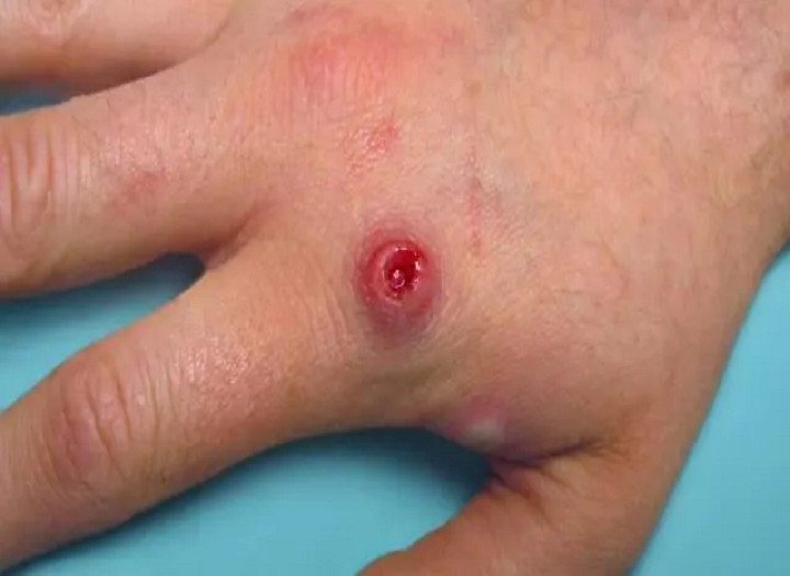 Förstå Monkeypox och hur man kan förhindra det？