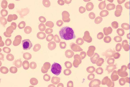 Babio lanserar Giemsa-fläcklösning av hög kvalitet för globala laboratorier